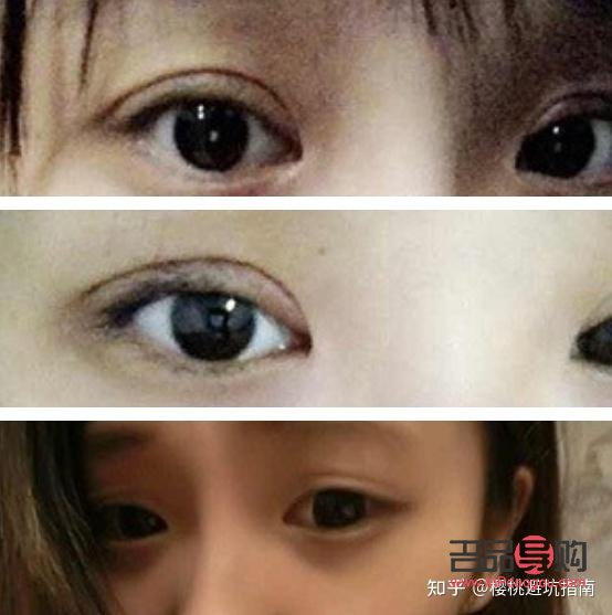 雙眼皮圖片類型(雙眼皮圖片類型大全)