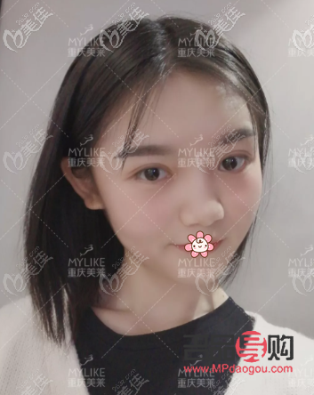 雙眼皮圖片類型(雙眼皮圖片類型大全)