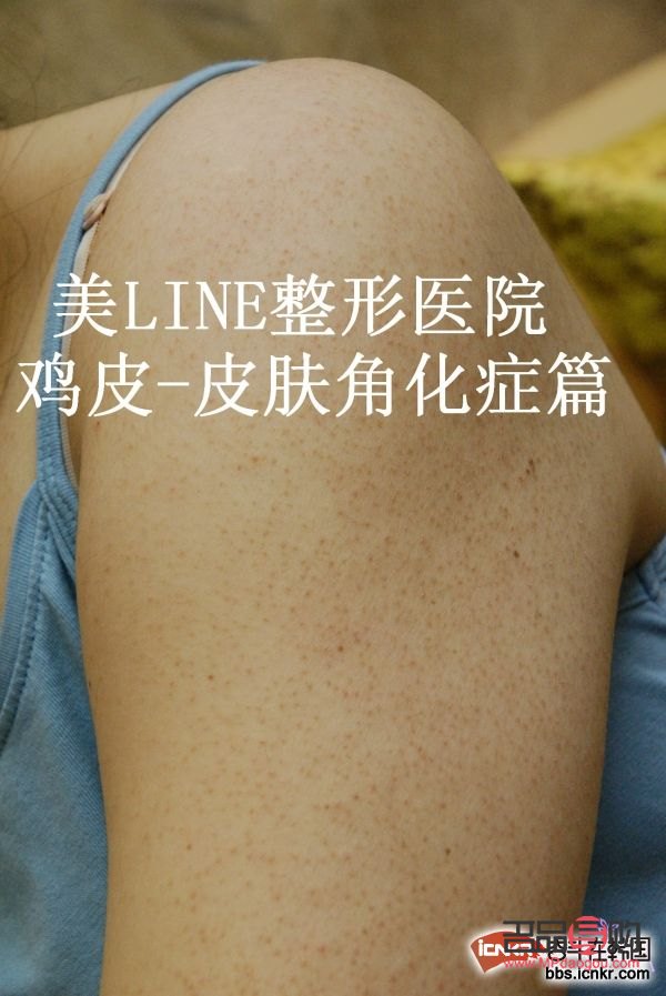 身體護(hù)理祛雞皮效果探討