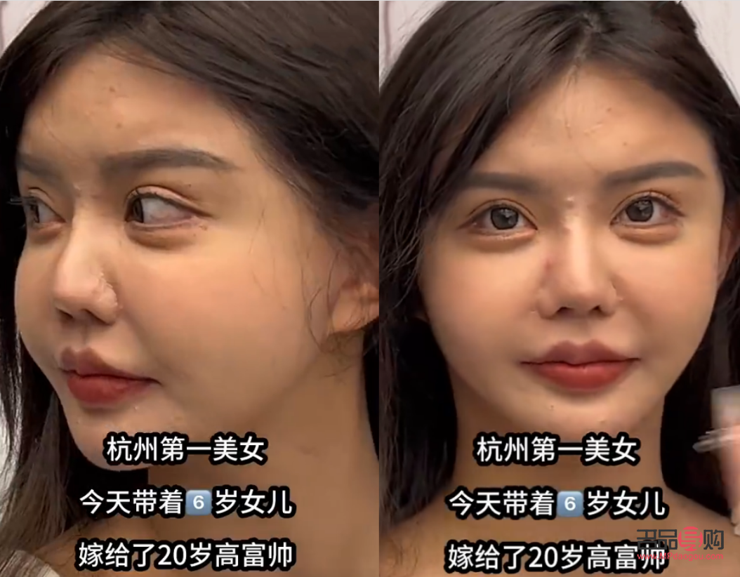 一只眼睛臥蠶腫脹原因及應對方法