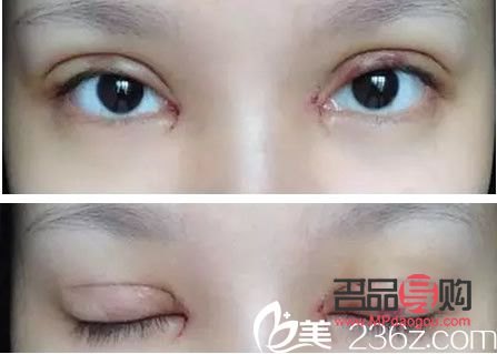 雙眼皮7mm恢復(fù)后多寬圖片男(雙眼皮7mm恢復(fù)后多寬圖片男生)