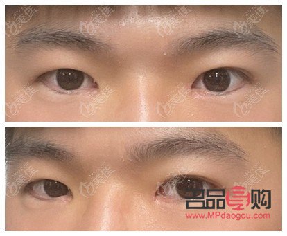 雙眼皮7mm恢復(fù)后多寬圖片男(雙眼皮7mm恢復(fù)后多寬圖片男生)