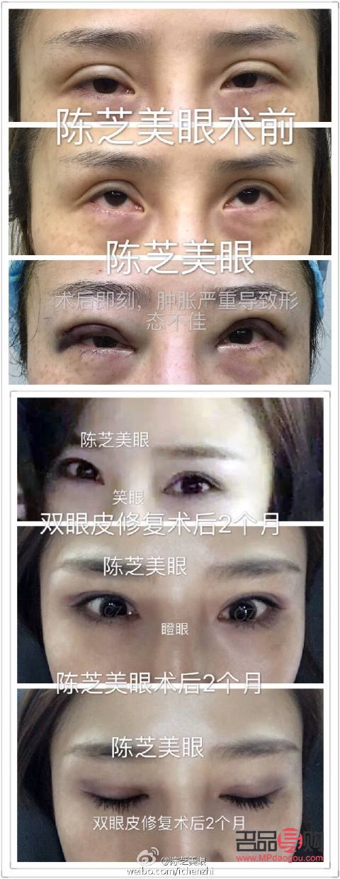 <h3>雙眼皮手術對老年時期的影響探究</h3>