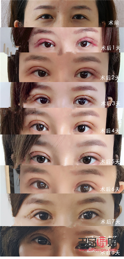 <h3>雙眼皮手術對老年時期的影響探究</h3>