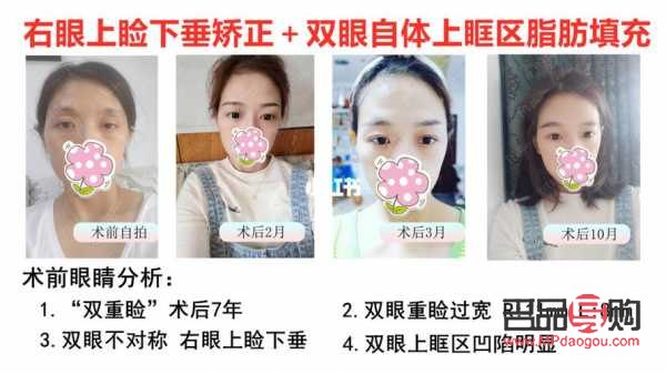 對眼矯正手術(shù)多少錢安陽市(對眼矯正的最佳年齡)