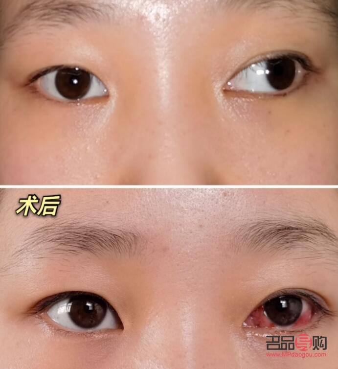 對眼矯正手術多少錢安陽市(對眼矯正的最佳年齡)