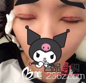 <h3>選擇最佳季節(jié)割雙眼皮，美麗更需安全相伴</h3>