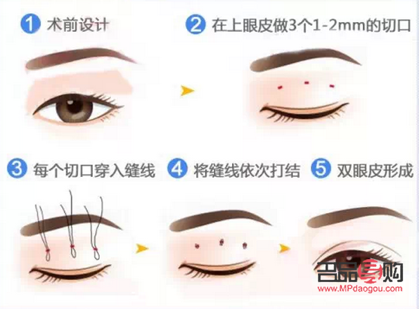 <h3>選擇最佳季節(jié)割雙眼皮，美麗更需安全相伴</h3>