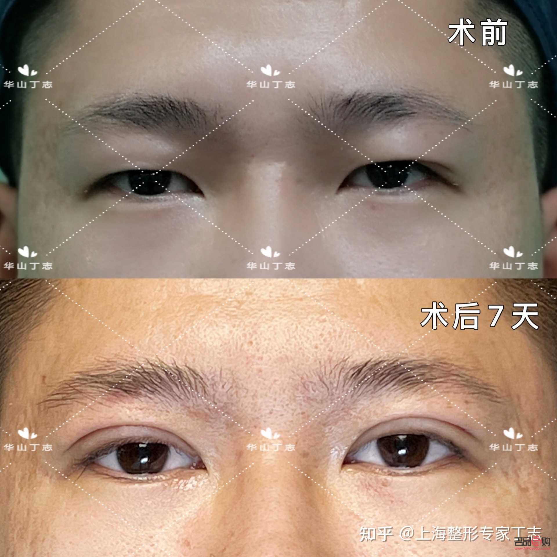 男人腫眼泡需要做什么手術(shù)(男人腫眼泡需要做什么手術(shù)?)