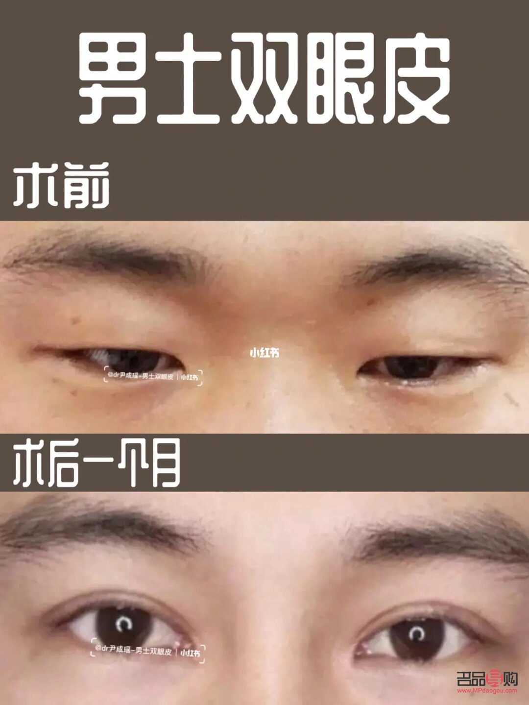 男人腫眼泡需要做什么手術(男人腫眼泡需要做什么手術?)