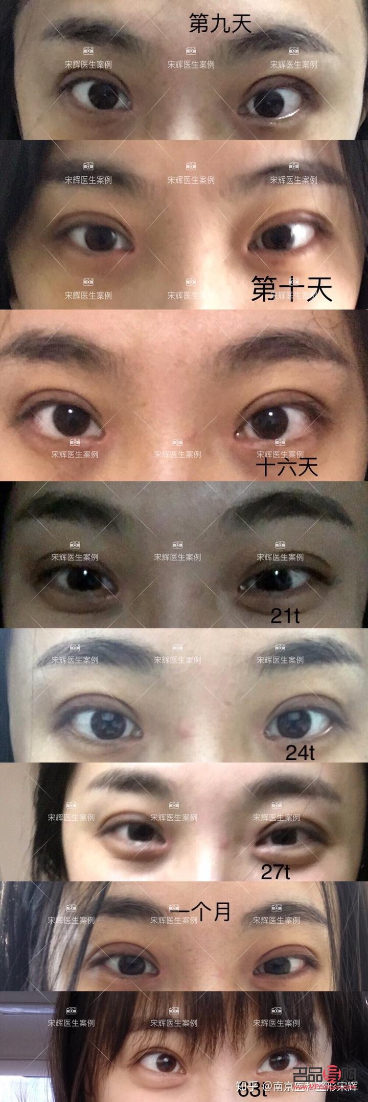 <h3>內(nèi)雙與雙眼皮手術(shù)：值得考慮的選擇？</h3>