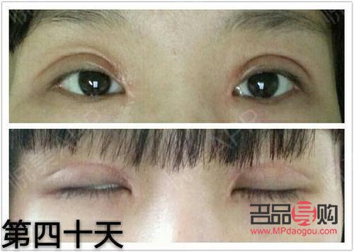 內(nèi)雙與雙眼皮手術：值得考慮的選擇？