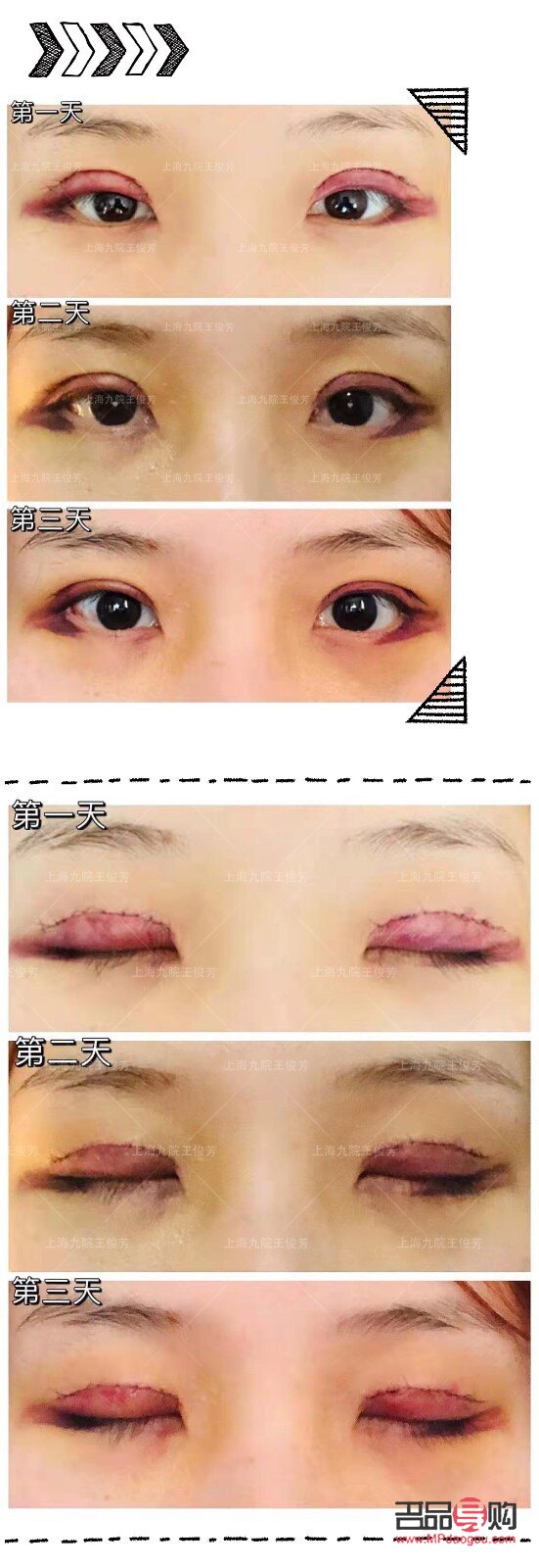 <h3>探尋最佳雙眼皮效果：哪款雙眼皮手術(shù)效果最理想？</h3>