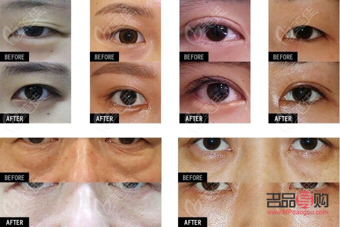 <h3>探尋去眼下皺紋的費(fèi)用之謎</h3>