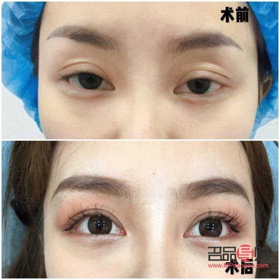 雙眼皮的多樣眼型圖解