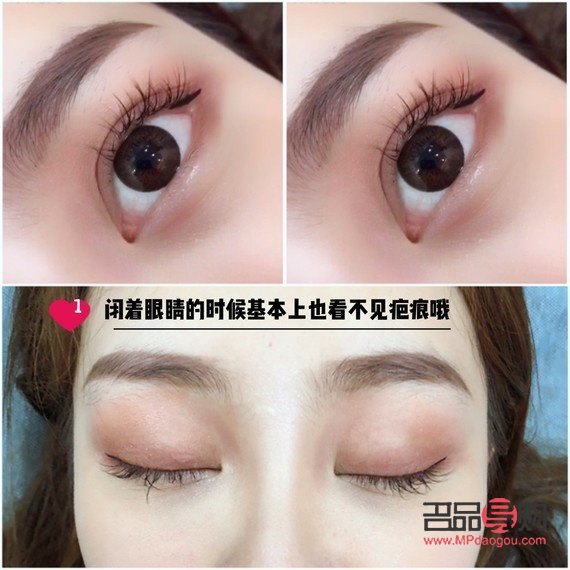 雙眼皮的多樣眼型圖解