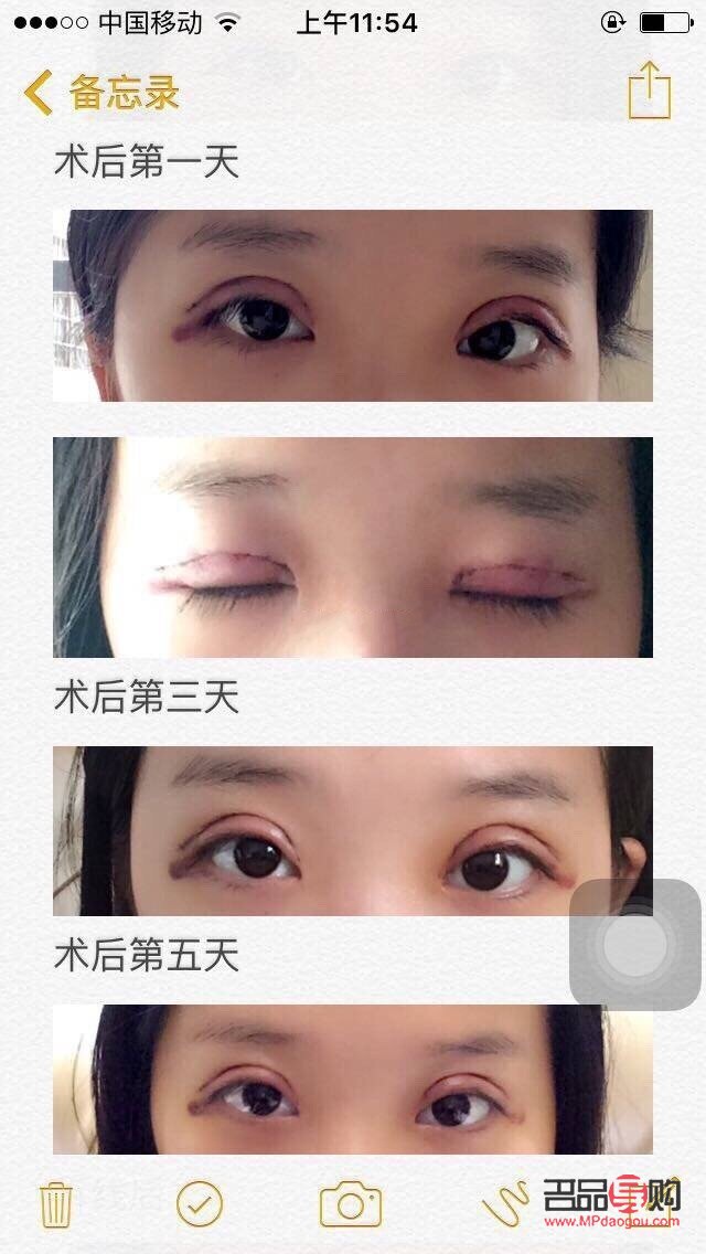 全切雙眼皮可以做幾次(全切雙眼皮可以做幾次修復(fù))