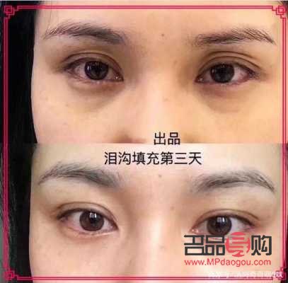 填充眼窩大概多少錢(填充眼窩大概多少錢一次)