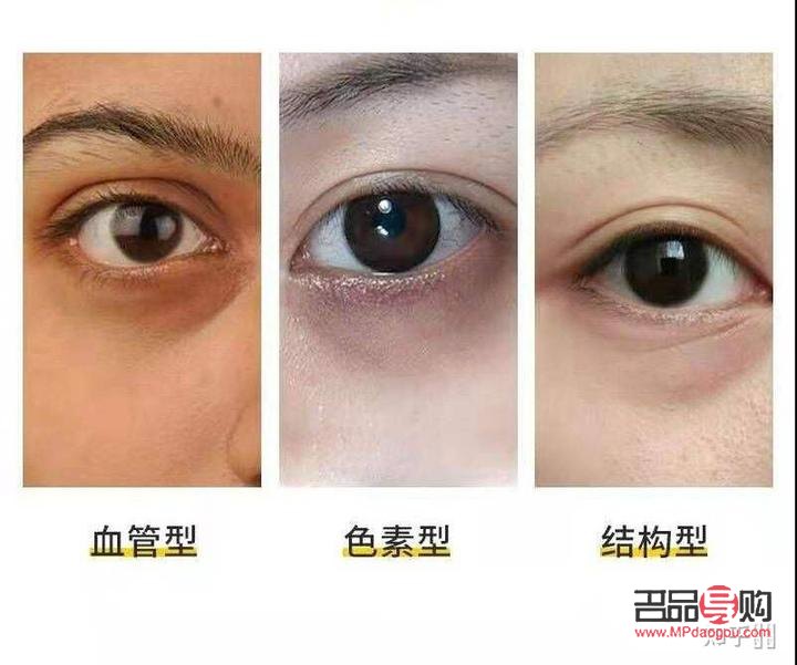 眼部黑色素代謝不出來怎么辦(黑眼圈激光一次多少錢)