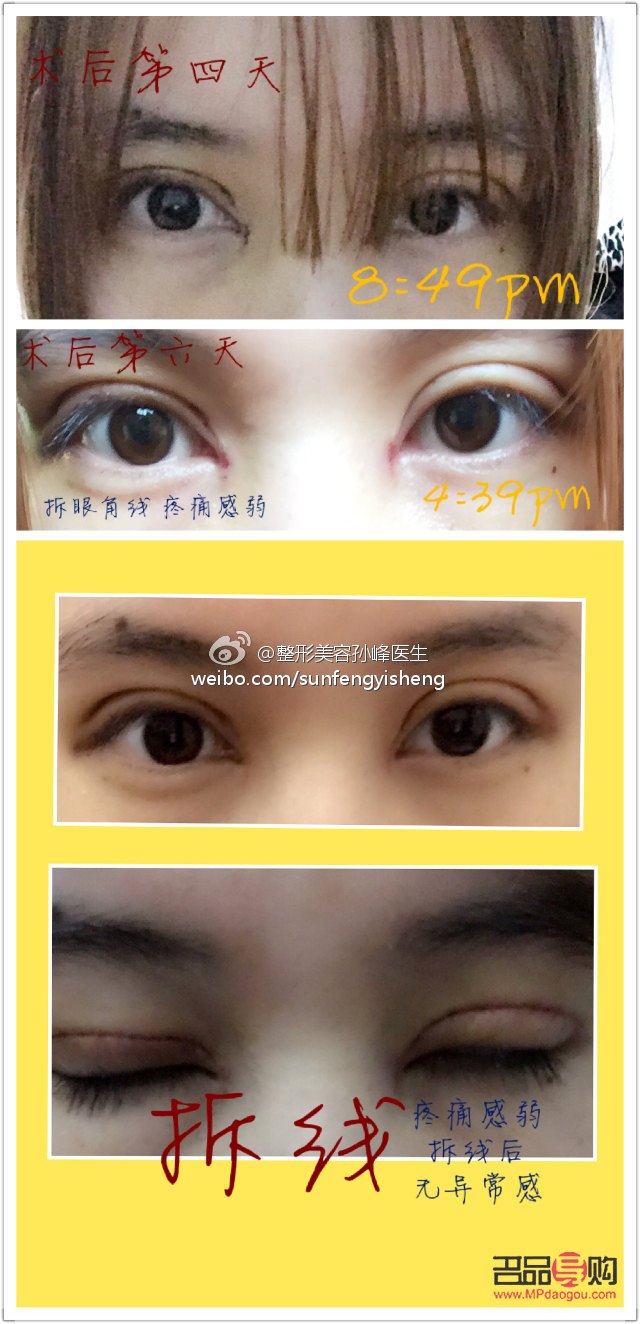 雙眼皮剛拆線效果圖解析及術(shù)后護理指南
