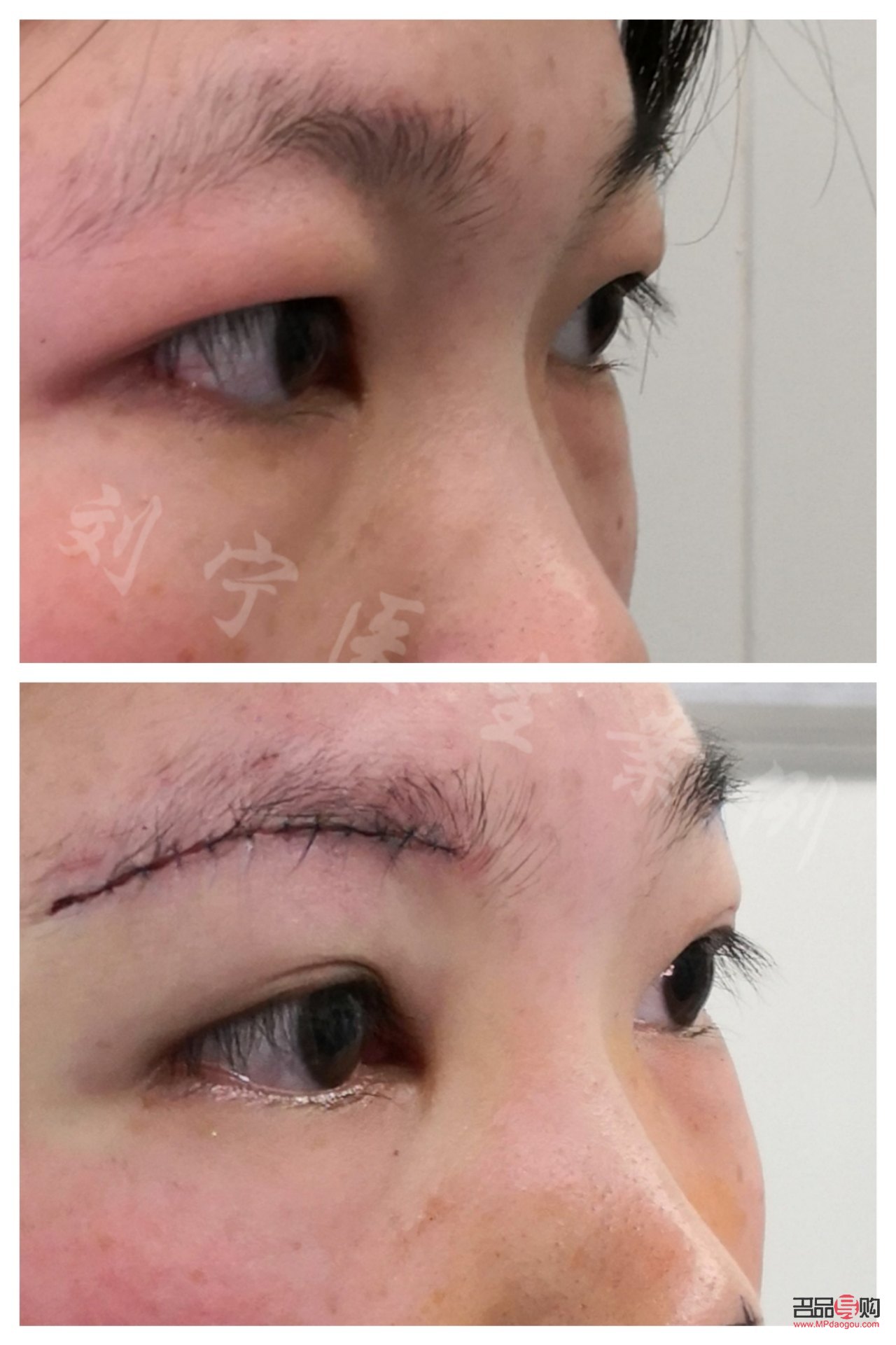 <h3>探究小朋友眼泡腫脹的成因</h3>