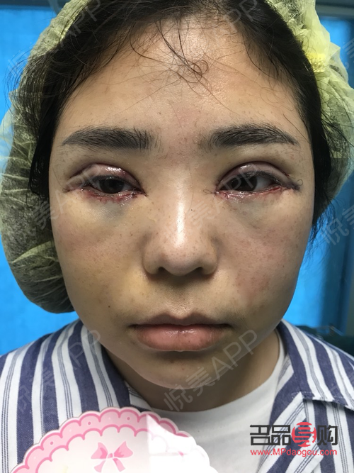 <h3>雙眼皮手術(shù)后，冰敷眼睛的正確方式</h3>