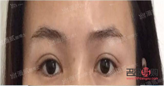 上眼皮長脂肪怎么辦(眼皮上長了個脂肪塊怎么去除)