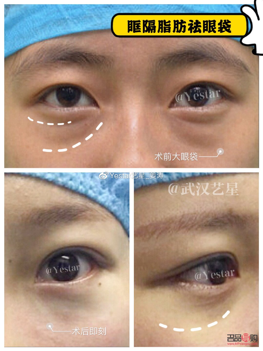 小學(xué)生如何去眼袋(小學(xué)生如何去眼袋最有效)