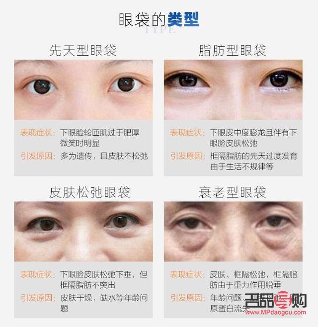 小學(xué)生如何去眼袋(小學(xué)生如何去眼袋最有效)