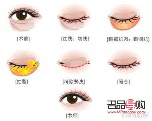 <h3>眼部抽脂手術(shù)費(fèi)用及注意事項(xiàng)</h3>