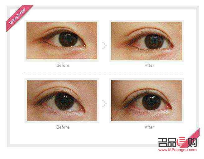 <h3>眼部抽脂手術(shù)費(fèi)用及注意事項(xiàng)</h3>