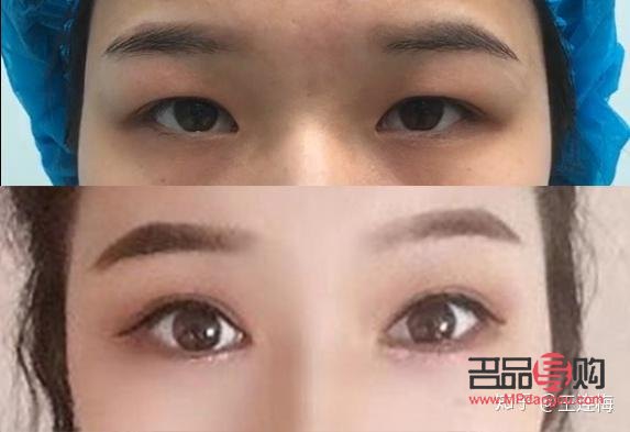 天生腫眼泡怎么治(天生腫眼泡怎么治呀)