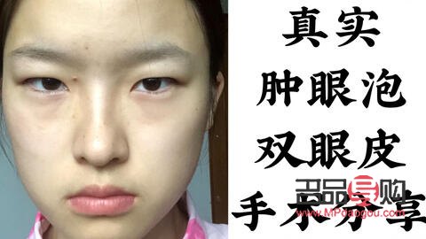 免麻雙眼皮的做法(免麻雙眼皮是什么技術(shù))