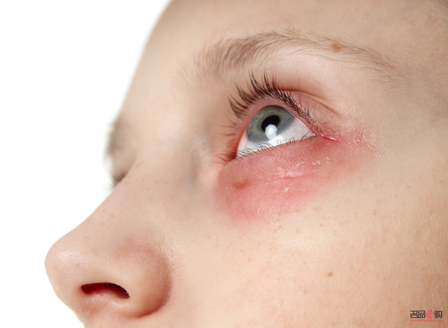 <h3>眼部過敏怎么辦？全面解析應對方法與注意事項</h3>