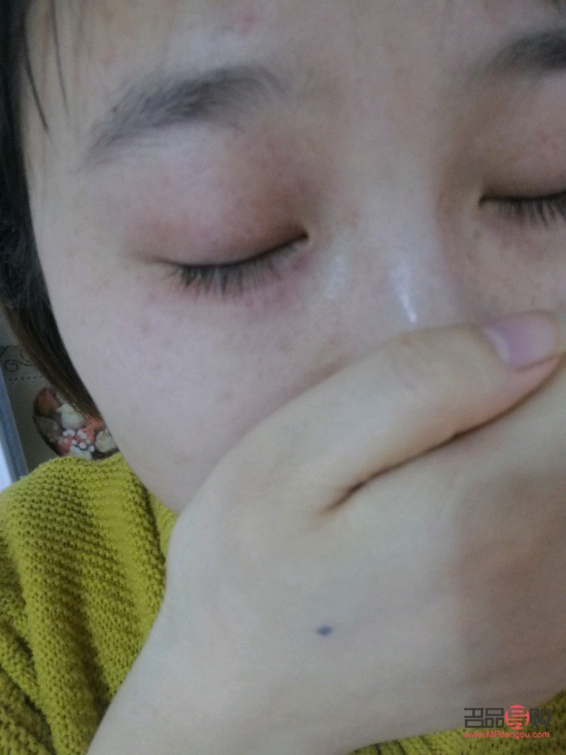 眼部過敏怎么辦？全面解析應對方法與注意事項