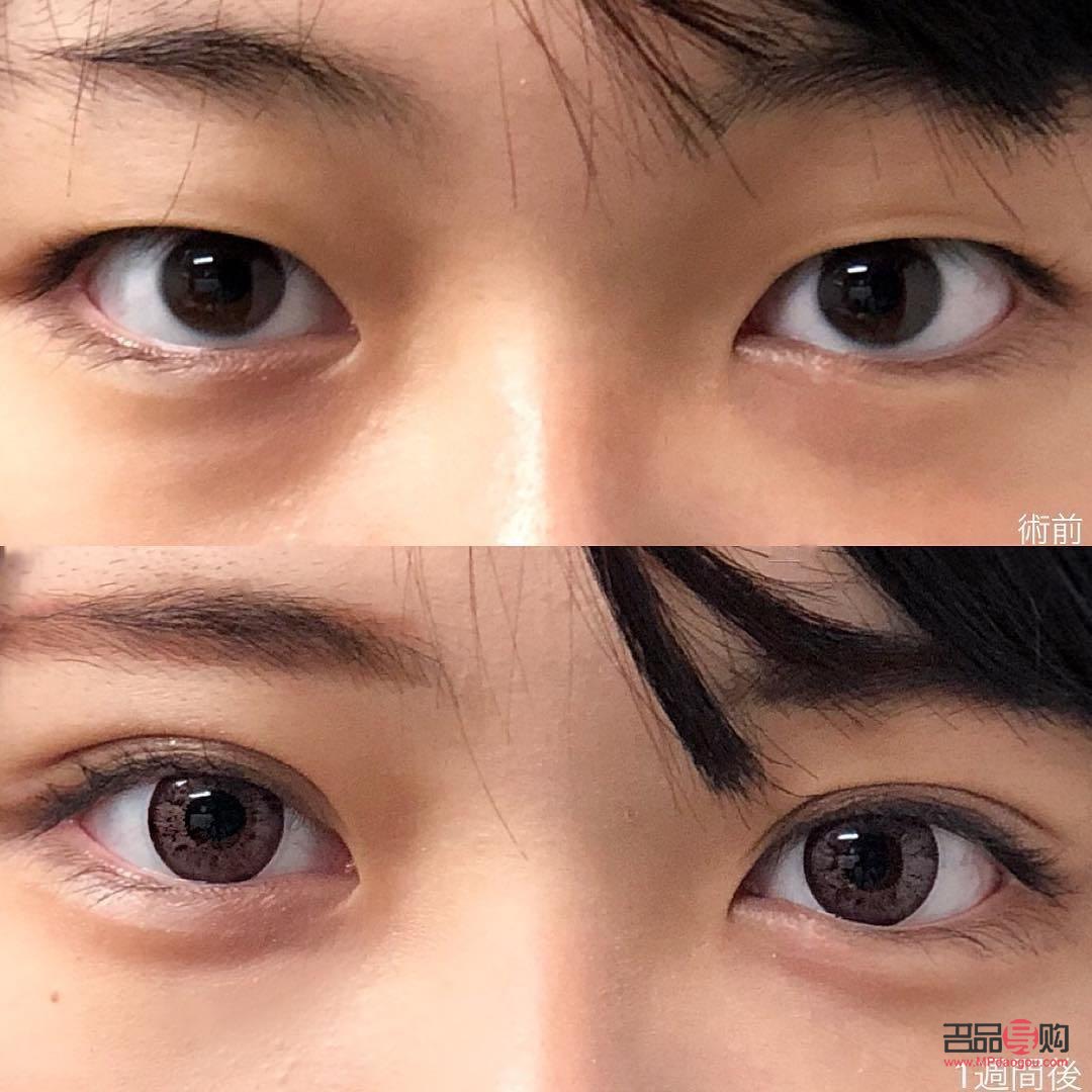 雙眼皮的人多還是單眼皮的人多(世界上雙眼皮的人多還是單眼皮的人多)