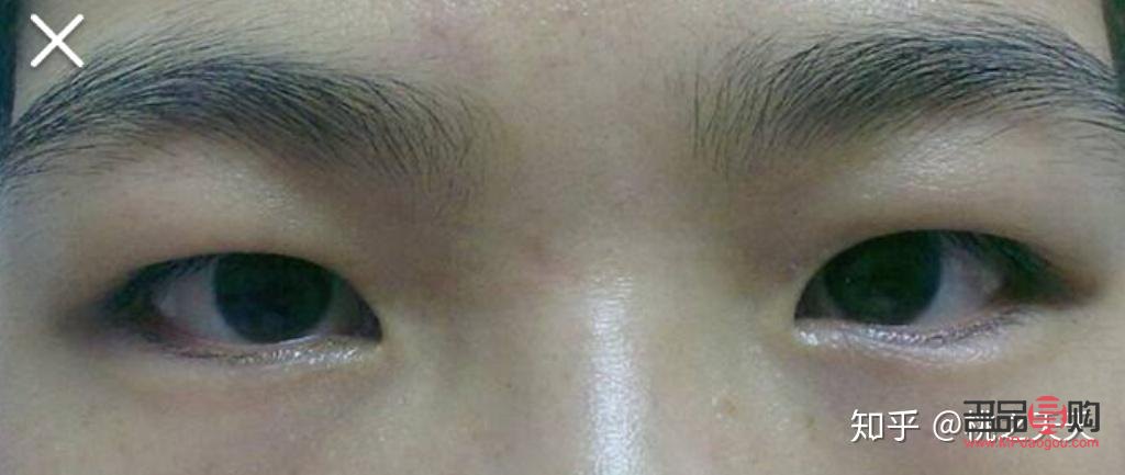 怎么改善天生的腫眼泡(怎么樣改變天生腫泡眼)