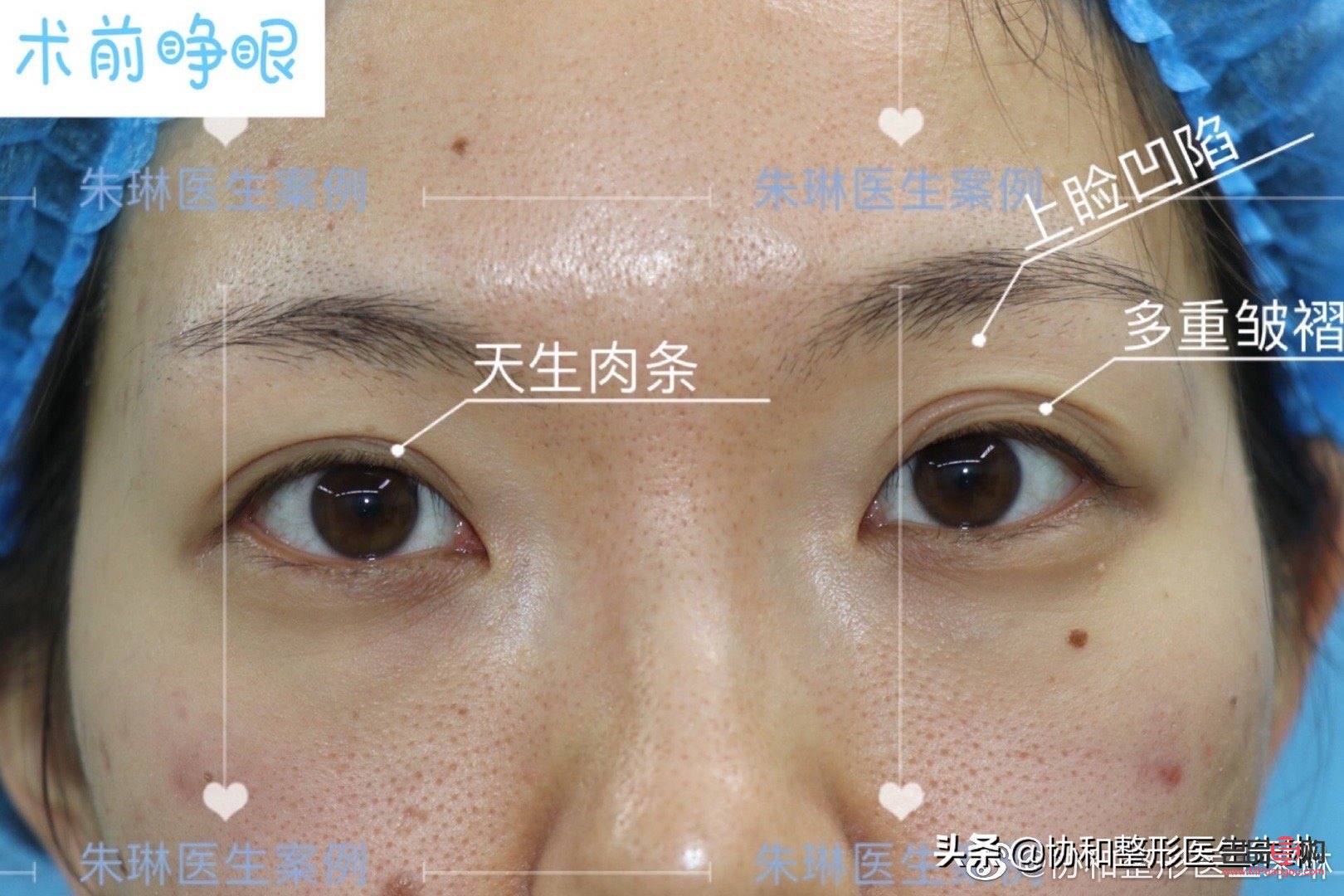 全切雙眼皮：美麗與風(fēng)險并存的選擇