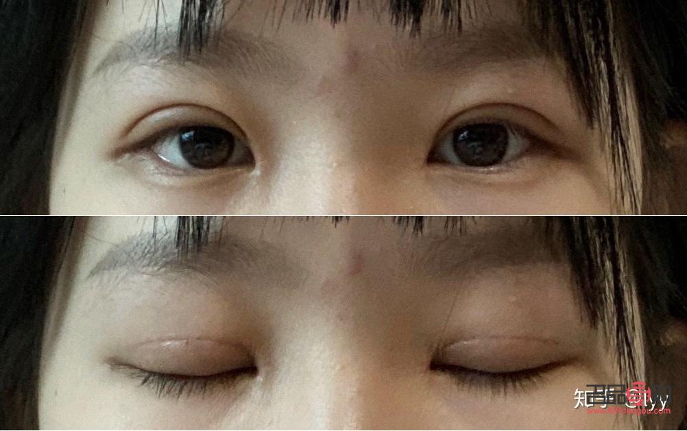 <h3>開扇雙眼皮恢復過程全解析</h3>
