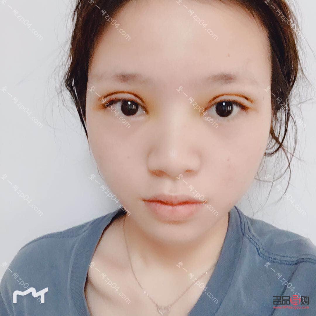 <h3>開扇雙眼皮恢復過程全解析</h3>