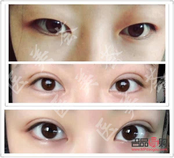 <h3>開扇雙眼皮恢復過程全解析</h3>