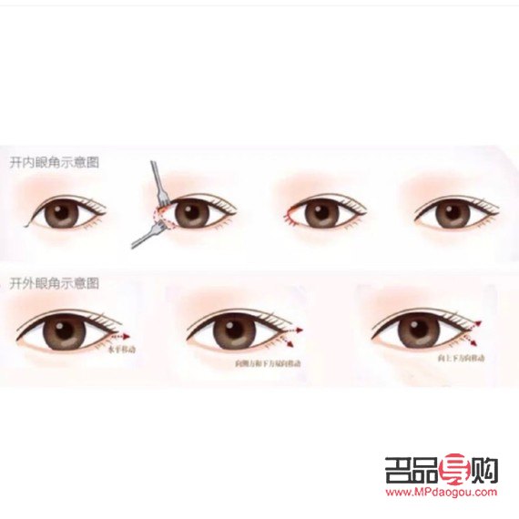 廣尾式雙眼皮(廣尾式雙眼皮圖片)