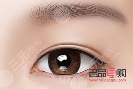 廣尾式雙眼皮(廣尾式雙眼皮圖片)