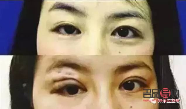 <h3>眼皮一邊內(nèi)雙一邊外雙怎么辦？解決雙眼皮不對(duì)稱問(wèn)題全攻略</h3>