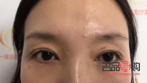 <h3>眼皮一邊內(nèi)雙一邊外雙怎么辦？解決雙眼皮不對(duì)稱問(wèn)題全攻略</h3>