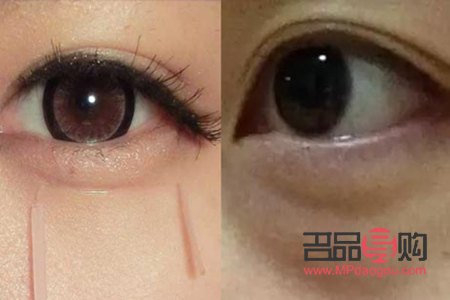 <h3>臥蠶與眼袋：笑容中的微妙差異</h3>