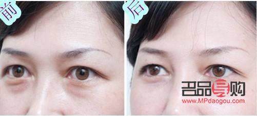 <h3>臥蠶與眼袋：笑容中的微妙差異</h3>