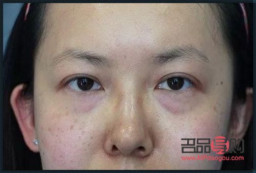 <h3>15歲有眼袋，原因何在？</h3>