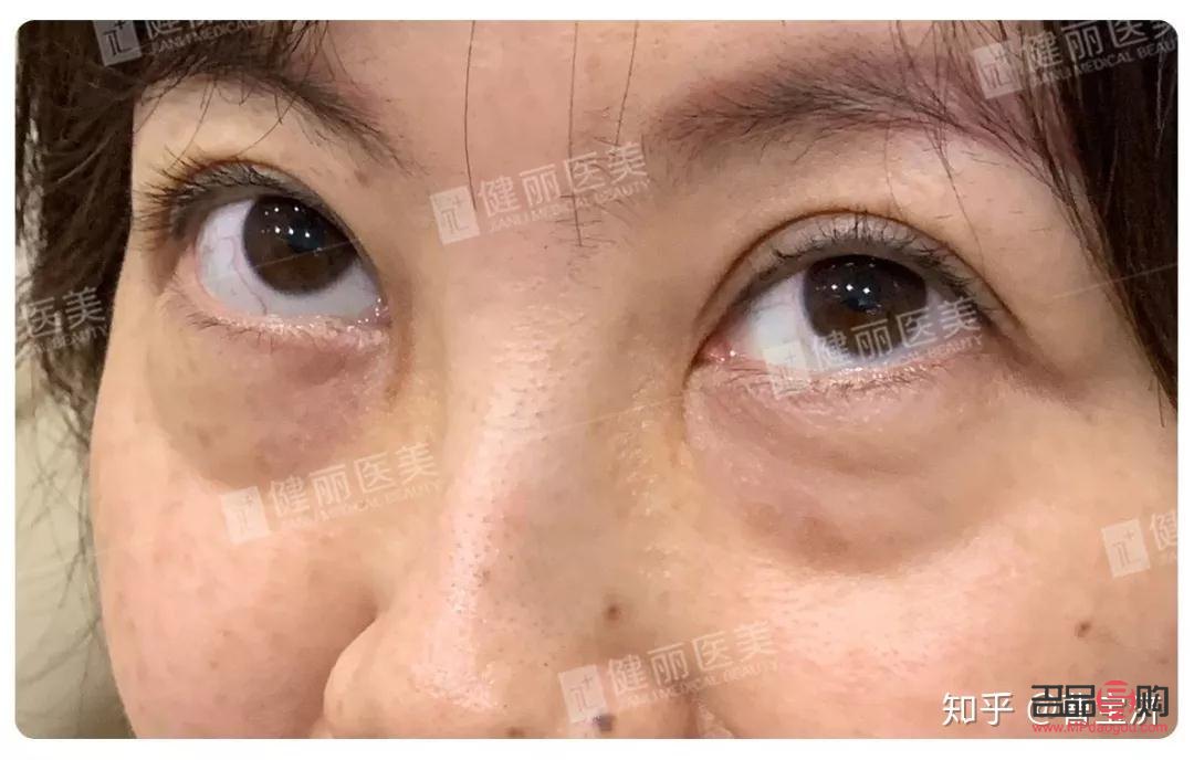 <h3>15歲有眼袋，原因何在？</h3>