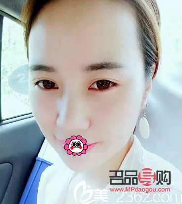 全切雙眼皮20天的狀態(tài)(全切雙眼皮20天的狀態(tài)圖片)